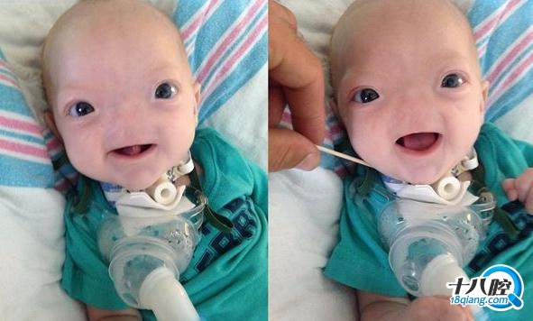 小婴儿出生就没有鼻子,可是当他笑起来却感动了亿万网友!