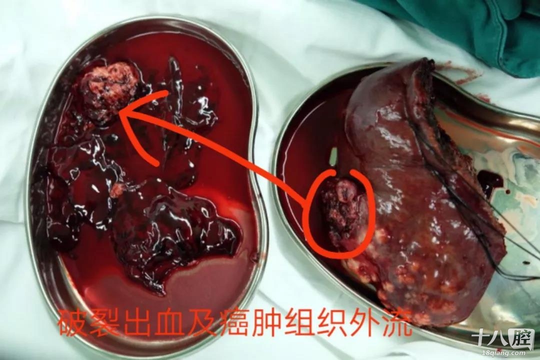 18岁义乌少年,居然肝癌晚期!只因忽视了这件事!教训太
