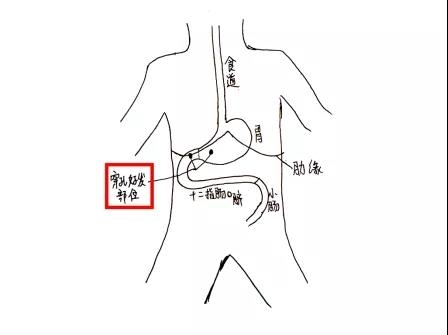 医生手绘图示,消化道穿孔好发部位