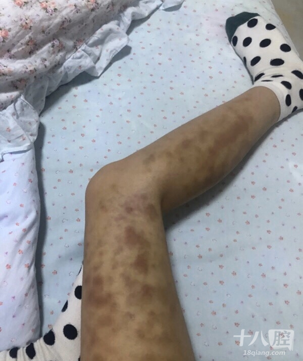 用狼牙棒滚了两天,两条腿成了这样
