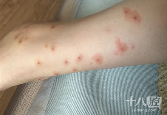 去乡下住了几天,腿被咬成了这样,也不知道是什么咬的,感觉好像是跳蚤