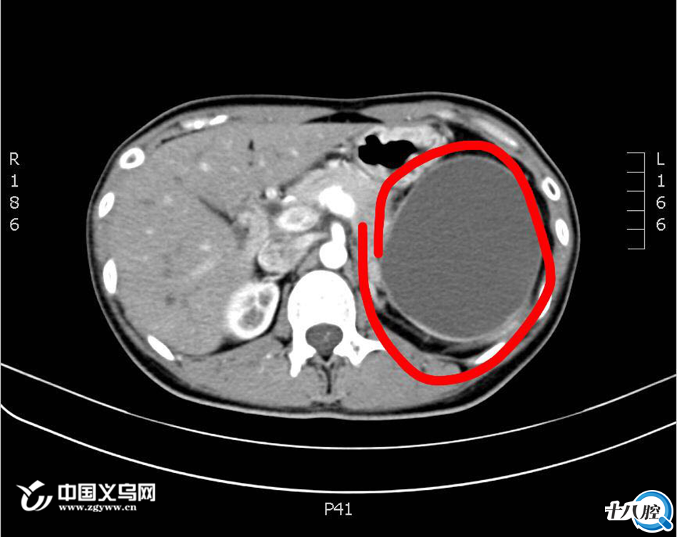 徐女士无意间觉得突然"肚子疼",原以为是胃病犯了,结果经腹部ct检查后
