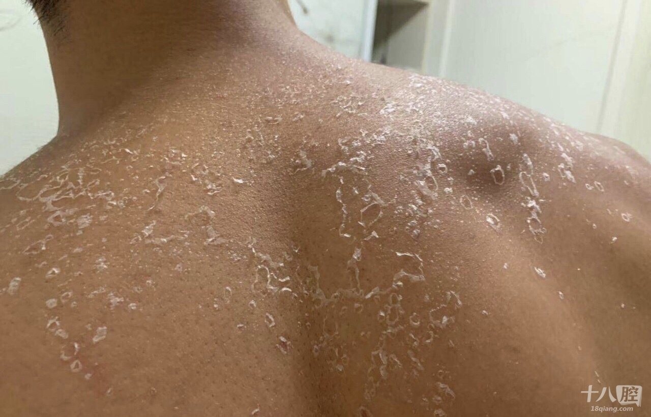 男人怎么会这个样子?防晒不肯涂,结果皮肤晒褪皮